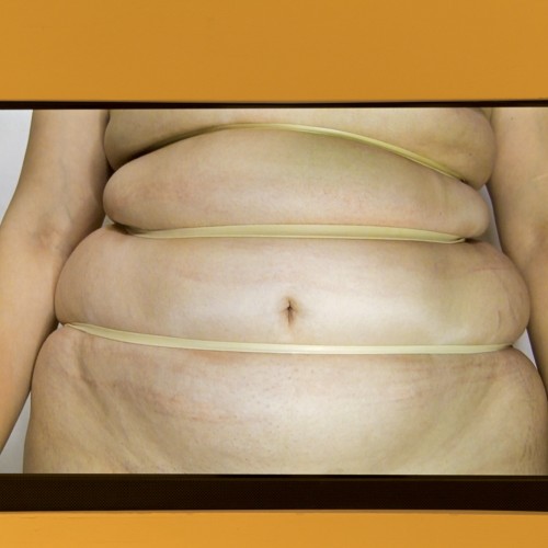 Video of a body stomach wrapped with 3 elastic bands.